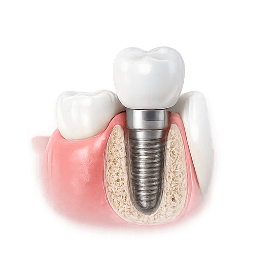 Dental Implants and Tooth Loss Solutions