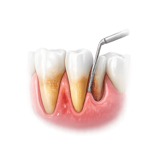 Periodontal Disease Treatment